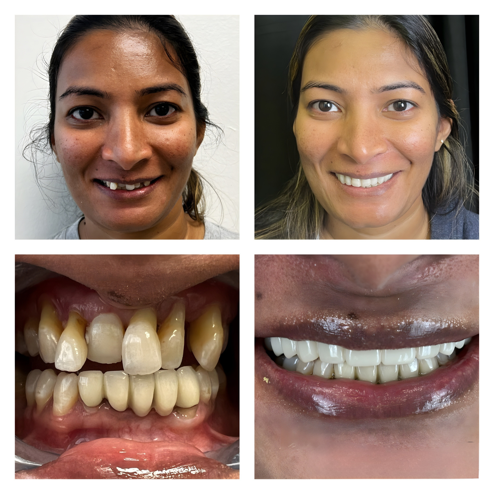 Before and after dental implant transformation 1