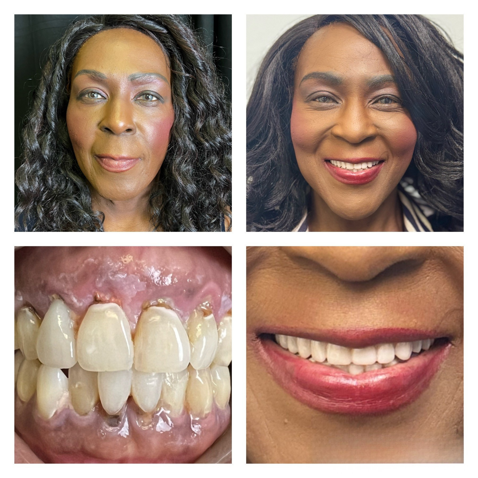 Before and after dental implant transformation 2