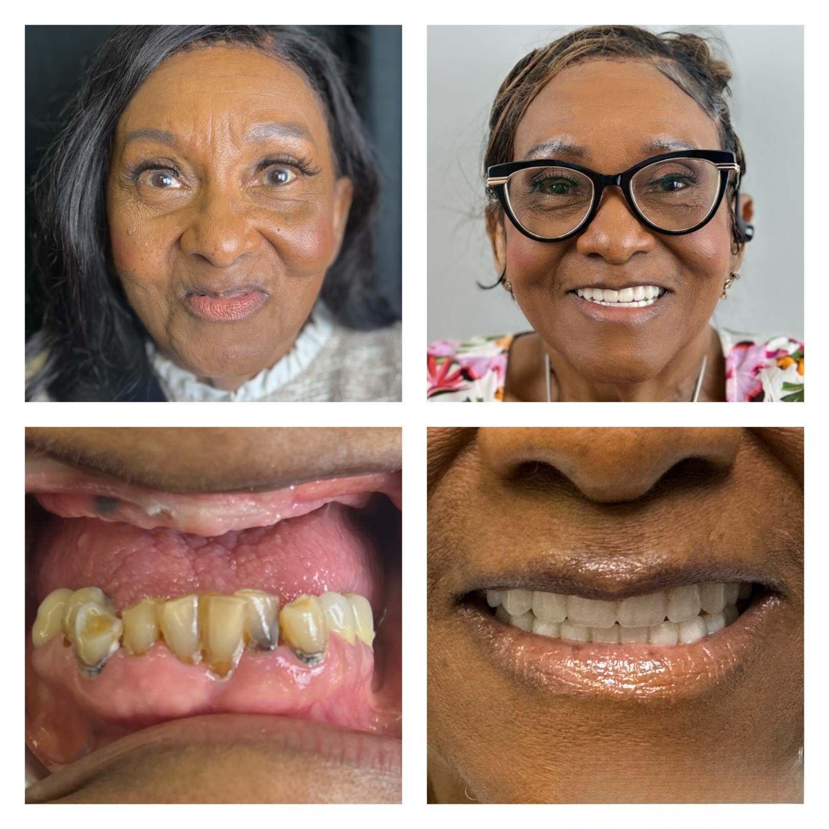 Before and after dental implant transformation 3