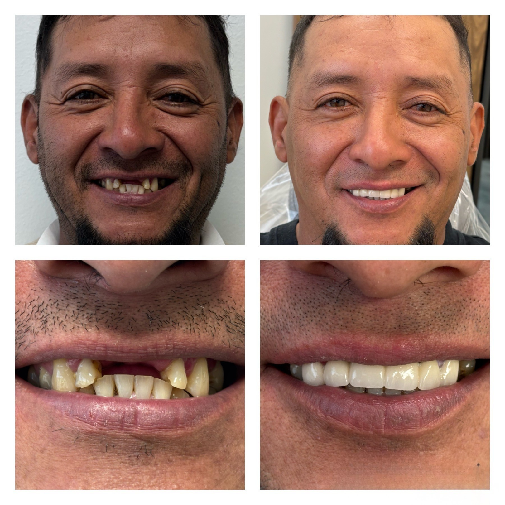 Before and after dental implant transformation 4
