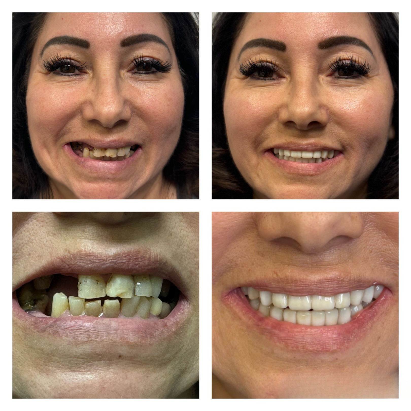 Before and after dental implant transformation 5