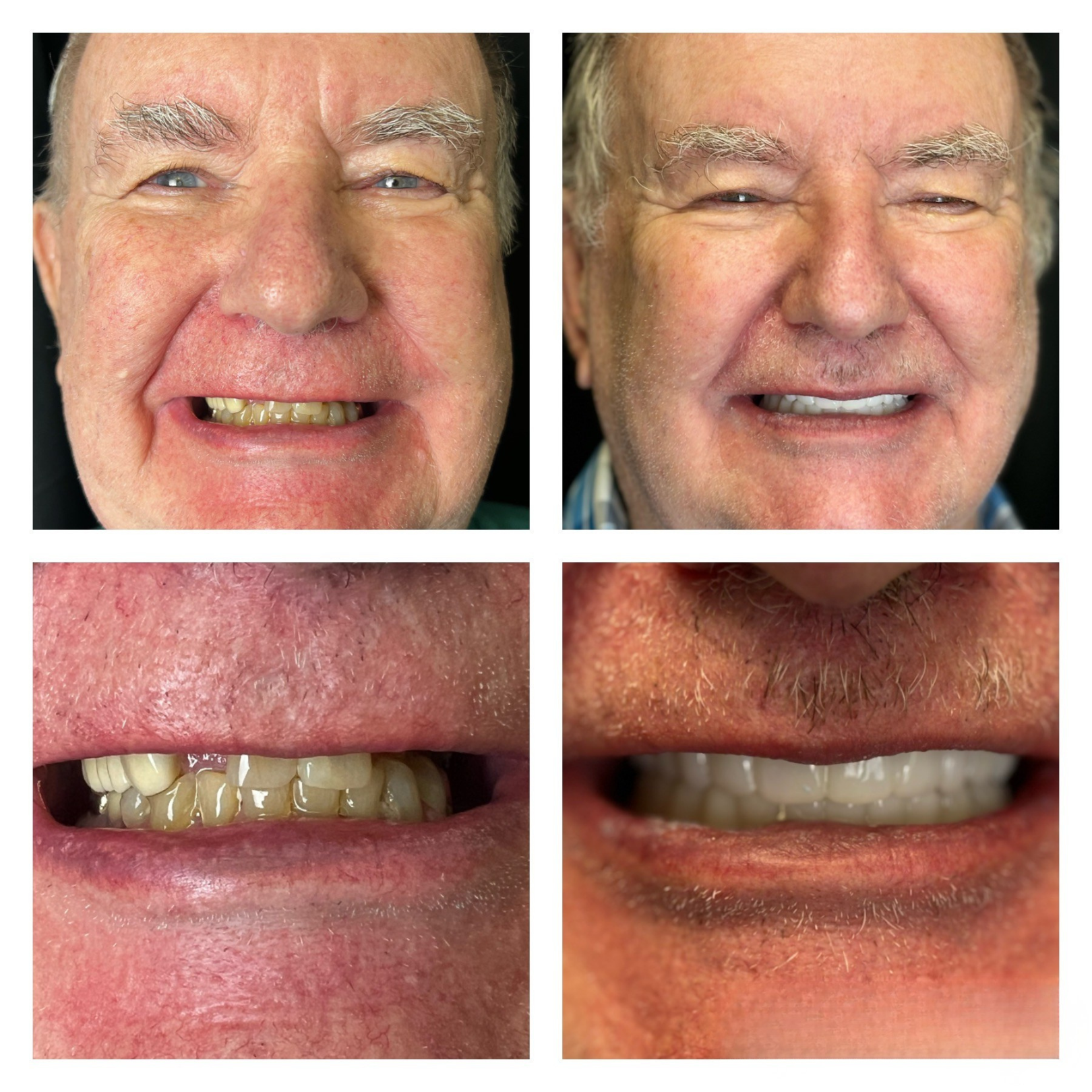 Before and after dental implant transformation 6
