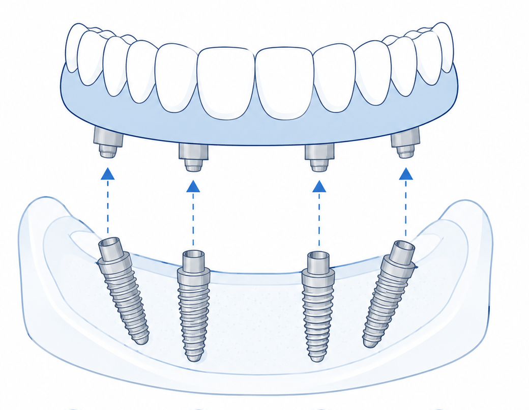Diagram showing a single full arch supported by four dental implants
