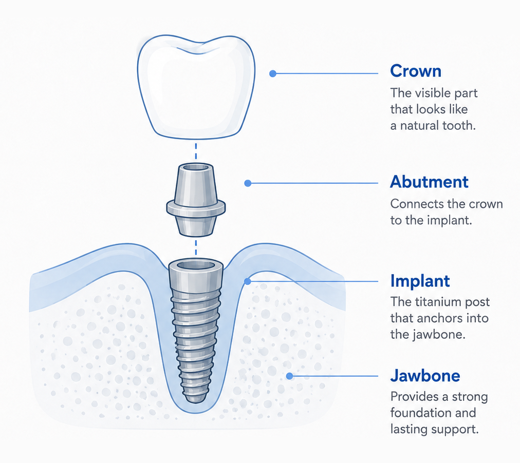 Diagram showing the parts of a single dental implant: crown, abutment, implant, and jawbone