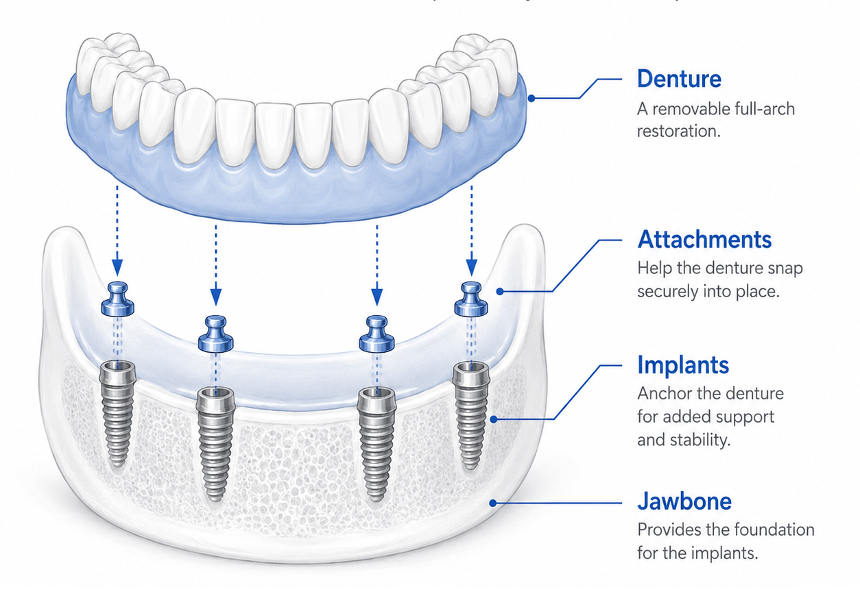Diagram of a snap-on denture with attachments anchored to implants